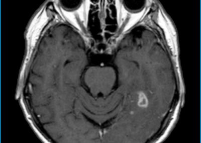 Colosimo et al. 52F Primary Glioma