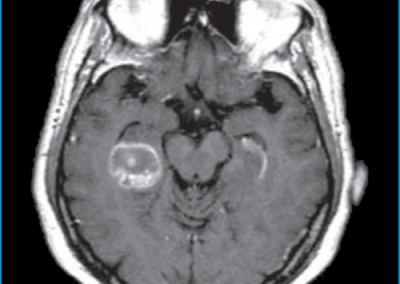 Colosimo et al. 50M Metastatic Renal Carcinoma