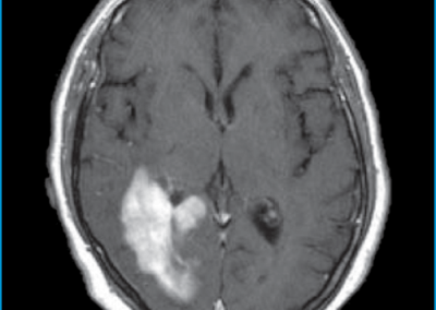 Colosimo et al. 72F Primary Cerebral Lymphoma