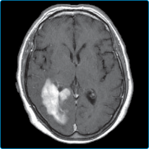 Colosimo et al. 72F Primary Cerebral Lymphoma