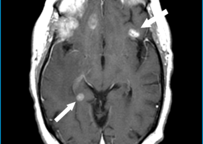 Maravilla et al. 51F Metastatic Lung Cancer