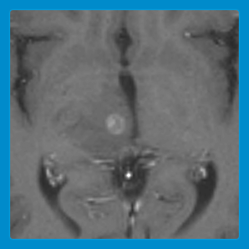 Seidl et al. 60F with Lung Cancer