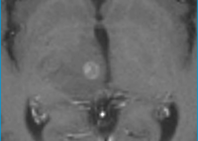 Seidl et al. 48F with Non-Hodgkins Lymphoma