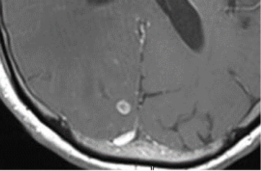 Brain Metastasis from Lung Adenocarcinoma 65M