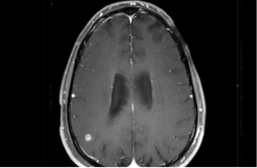 Brain Metastasis from Lung Cancer 38M