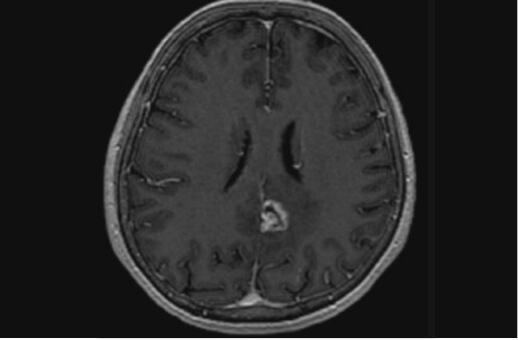 Brain Metastasis from Lung Cancer 65F