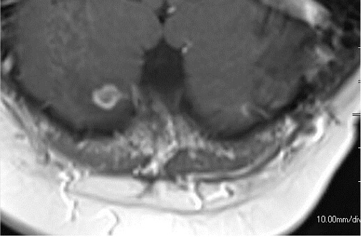 Brain metastasis from lung cancer 63F