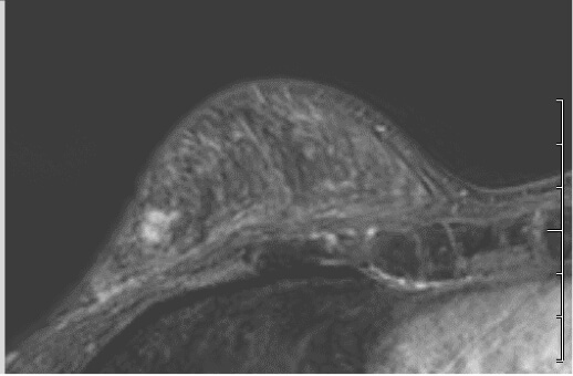 Cancer and Fibroadenoma 34F