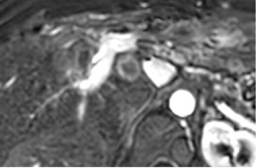 Cholangiocarcinoma 61M