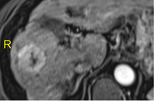 Cirrhotic Patient with Hepatocellular Carcinoma (HCC) 66M