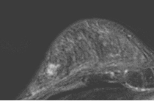 Fibroadenoma in Right Breast & Multicentric Cancer in Left Breast 34F