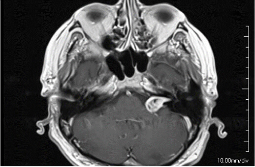 Left Vestibular Schwannoma 72M