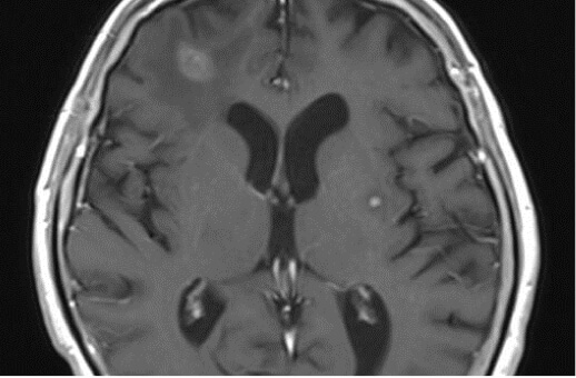 Multiple Metastases of Lung Cancer 76P