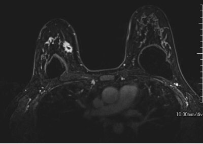 Right Breast Cancer with Breast Implants 44F