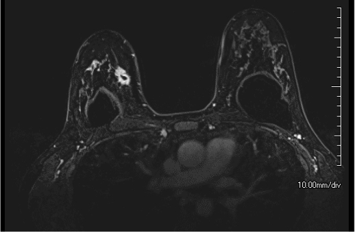 Right Breast Cancer with Breast Implants 44F