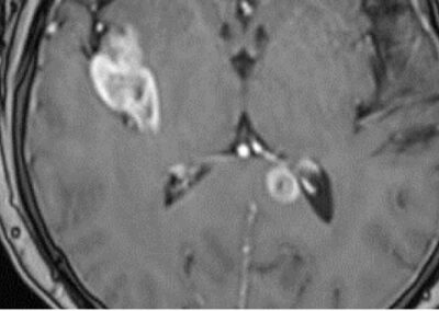 Right Frontal High-Grade Glial Tumor 62F