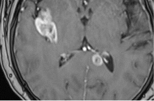 Right Frontal High-Grade Glial Tumor 62F