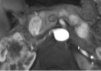 Right Kidney Cancer & Pancreatic Metastasis 61M