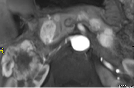 Right Kidney Cancer & Pancreatic Metastasis 61M